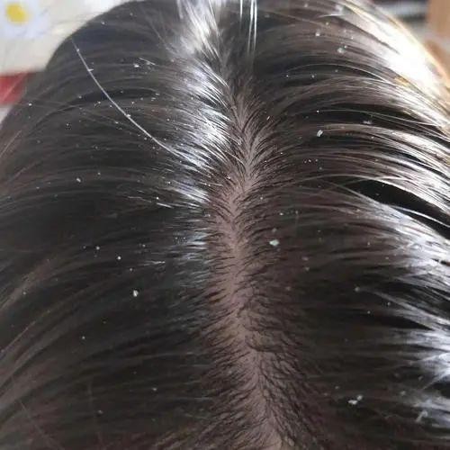 嘆頭部SPA！拒做人間油物解鎖防禿養(yǎng)發(fā)小妙招