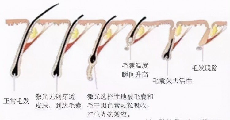 結(jié)腸SPA冰點(diǎn)脫毛光明有生活美容院違法做這些項(xiàng)目被查