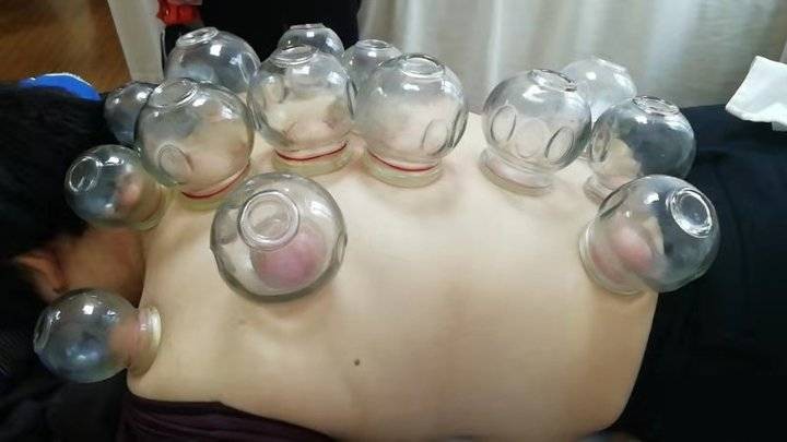 女演員SPA店拔火罐燒傷！省級醫(yī)學(xué)專家：拔火罐雖然好，但這些人并不適合