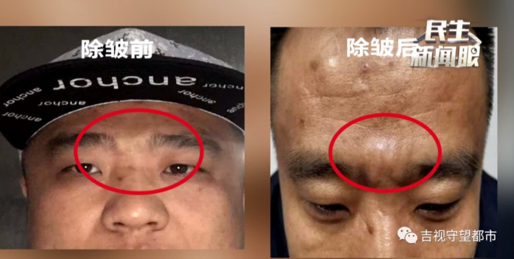 哥倆一心搞事業(yè)到長春幸福街纖手美容spa會所去川字紋結(jié)果卻變成了大包