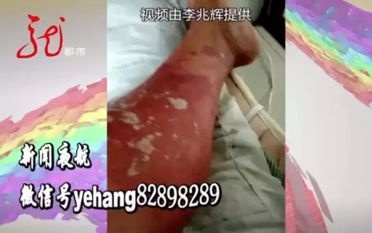 男子按摩之后出現(xiàn)紅腫水皰糜爛！有關(guān)部門已經(jīng)介入檢查