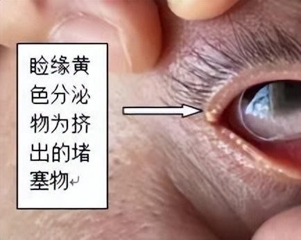 眼部SPA你聽過嗎南昌縣人民醫院五官科開展干眼SPA治療啦