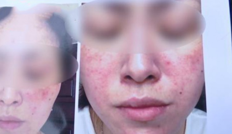 做完面部護理后，整個女人的臉都腫了？美容院：也許是她自己抓住的