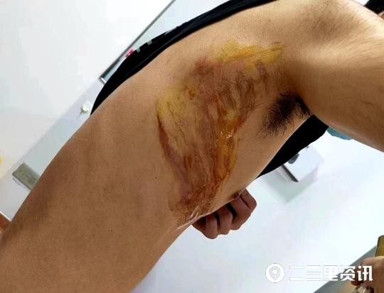 男子在咸陽一足浴店拔罐技師不慎引燃酒精致男子燒傷