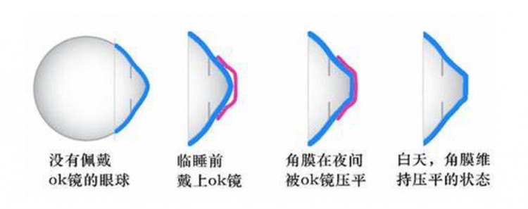 歐普康視——幫眼睛做個SPA毛利堪比茅臺