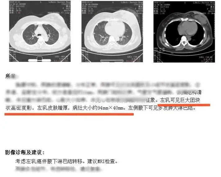 身體發現腫塊她選擇用按摩消除結果一年后崩潰了